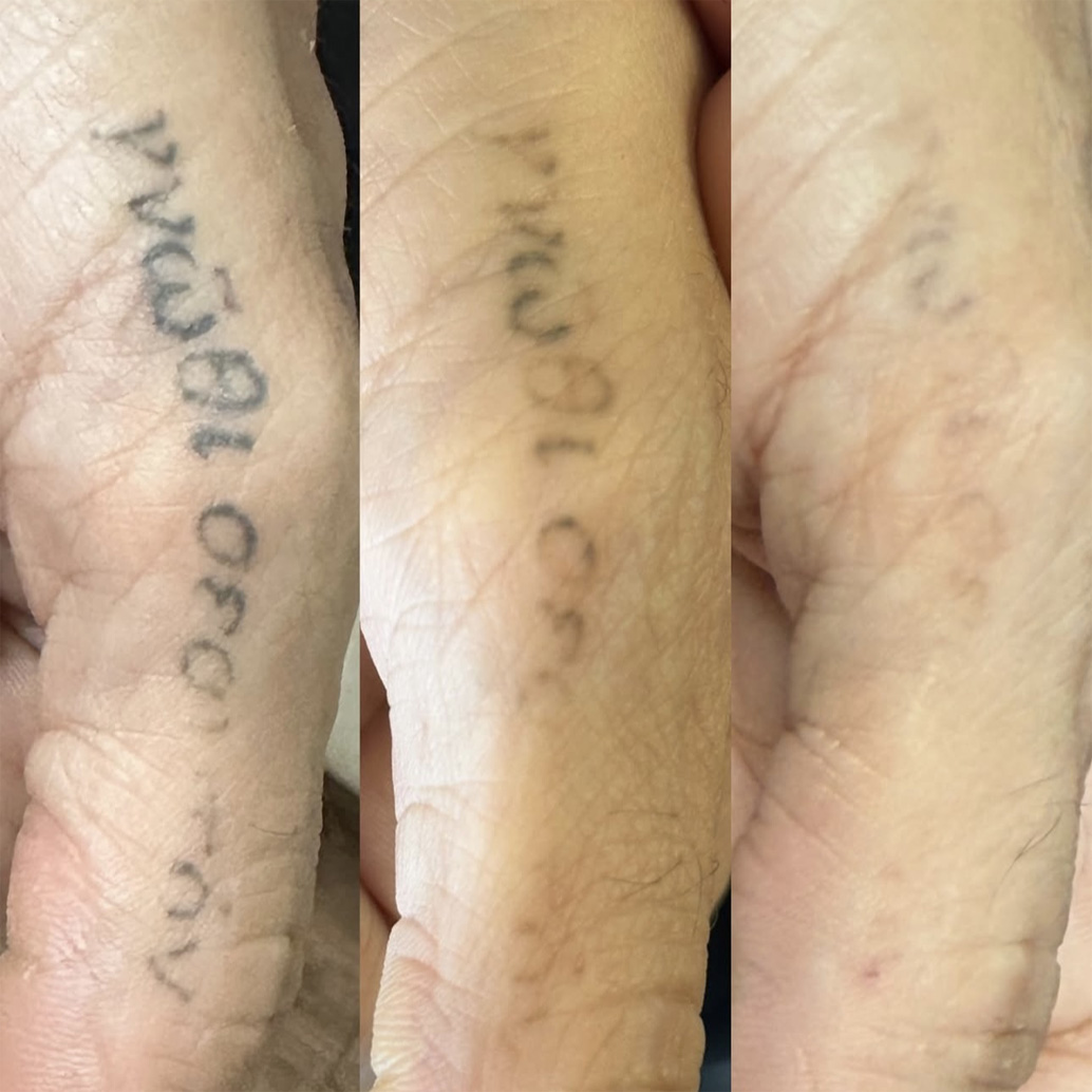 Resultado de remoção a laser – antes e depois