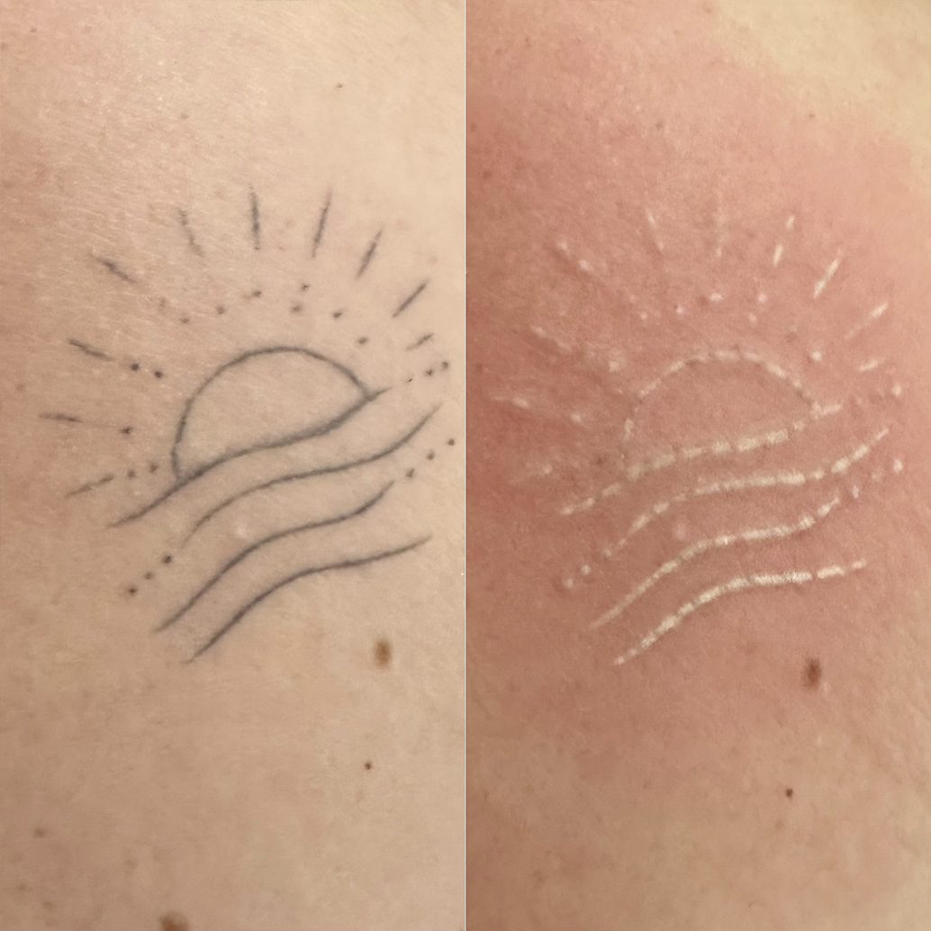 Resultado de remoção a laser – antes e depois