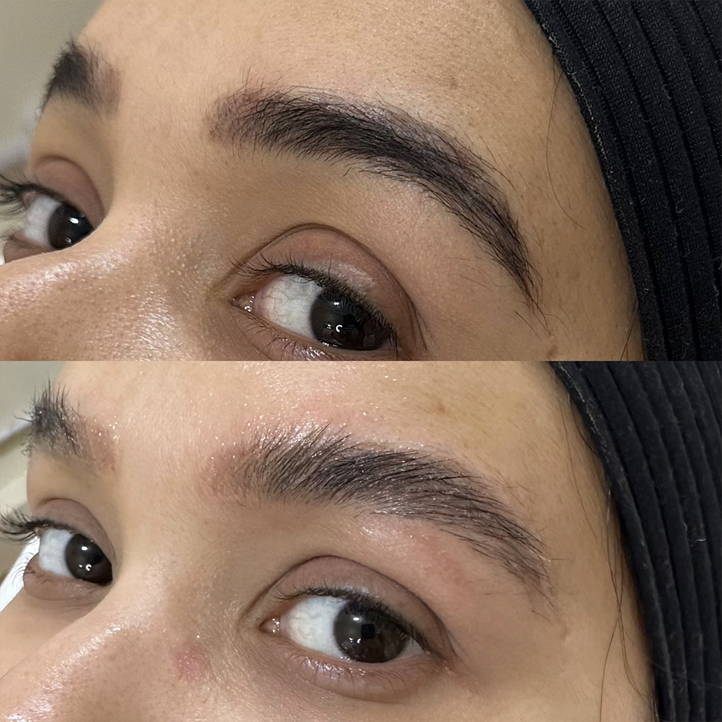 Resultado de remoção a laser – antes e depois