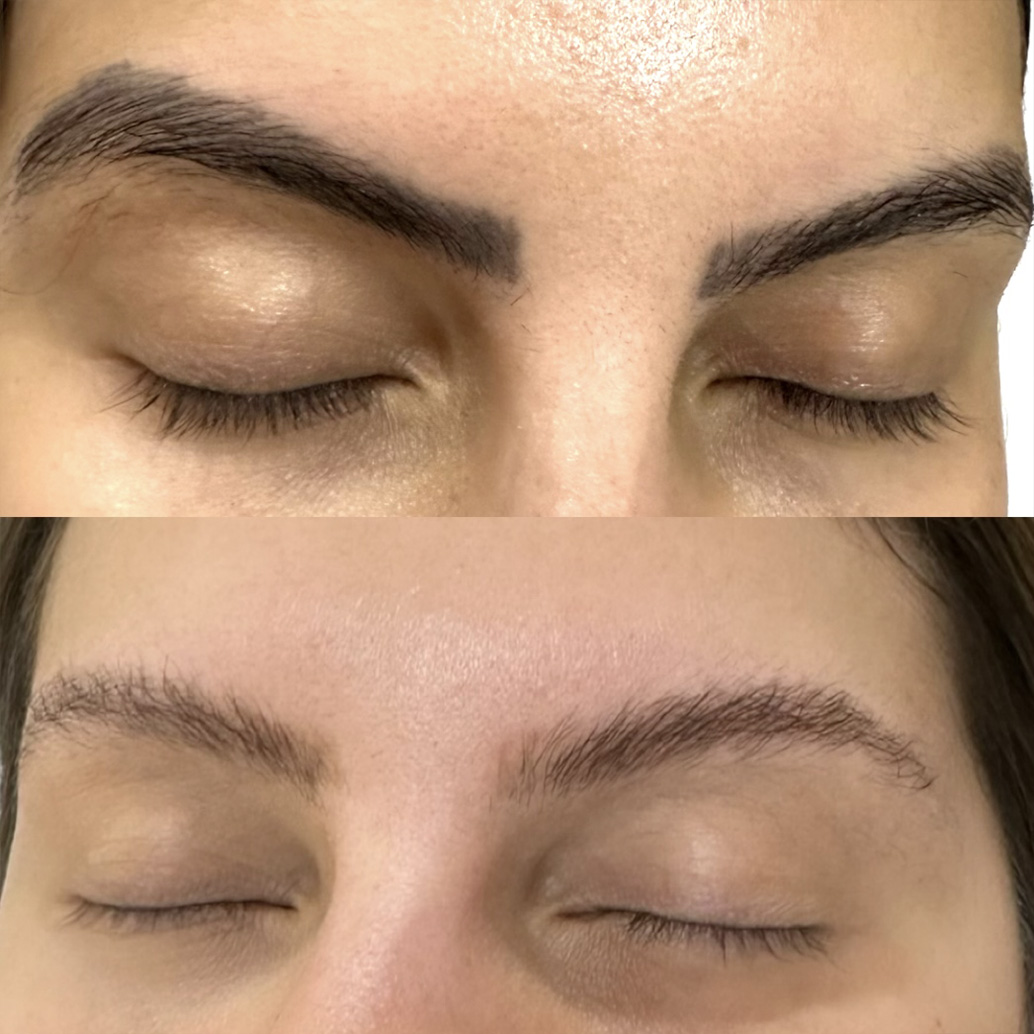 Resultado de remoção a laser – antes e depois