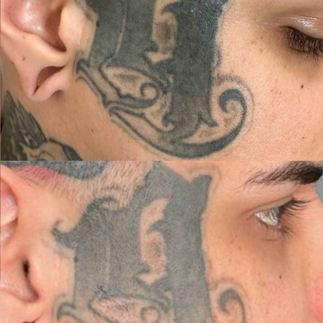Resultado de remoção a laser – antes e depois